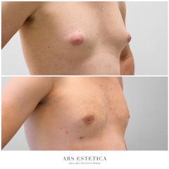 Ginekomastia - Dr n. med. Wojciech Rybak