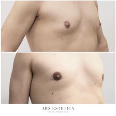 Ginekomastia - Dr n. med. Wojciech Rybak