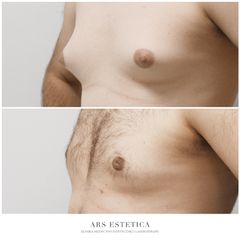Ginekomastia - Dr n. med. Wojciech Rybak