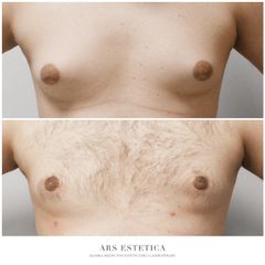 Ginekomastia - Dr n. med. Wojciech Rybak