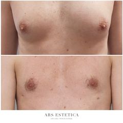 Ginekomastia - Dr n. med. Wojciech Rybak