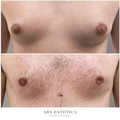 Ginekomastia - Dr n. med. Wojciech Rybak