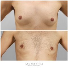 Ginekomastia - Dr n. med. Wojciech Rybak
