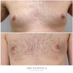 Ginekomastia - Dr n. med. Wojciech Rybak