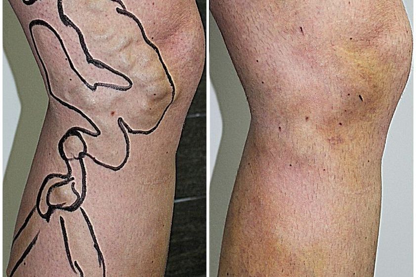 Laserowe usuwanie żylaków przed i po - 850862
