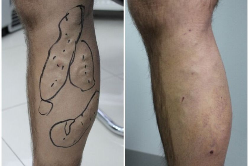 Laserowe usuwanie żylaków przed i po - 850863