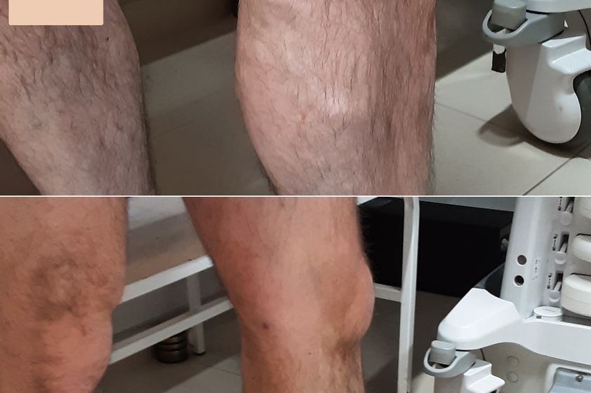 Laserowe usuwanie żylaków przed i po - 872387