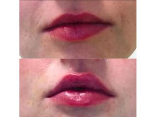 Przed i po - Powiększanie ust kwasem hialuronowym