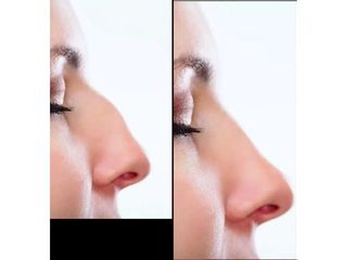 Przed i po - Operacja plastyczna nosa efekty zabiegu