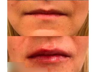 Powiększanie ust - dr Joanna Wiśniewska - Goryń