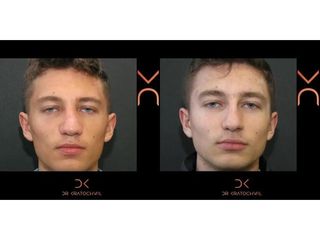 Rhinoplastyka - efekty