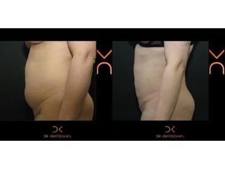 Liposukcja brzucha - efekty