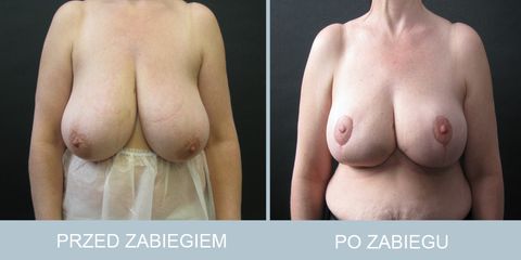 redukcja_piersi_1-2