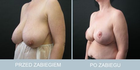 redukcja_piersi_2-2