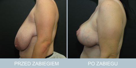 redukcja_piersi_113