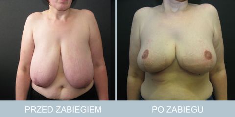 redukcja_piersi_211