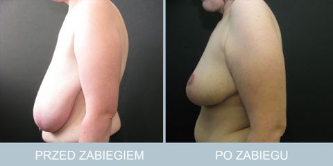 redukcja_piersi_213