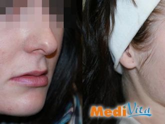 Laserowe usuwanie blizn - 653212