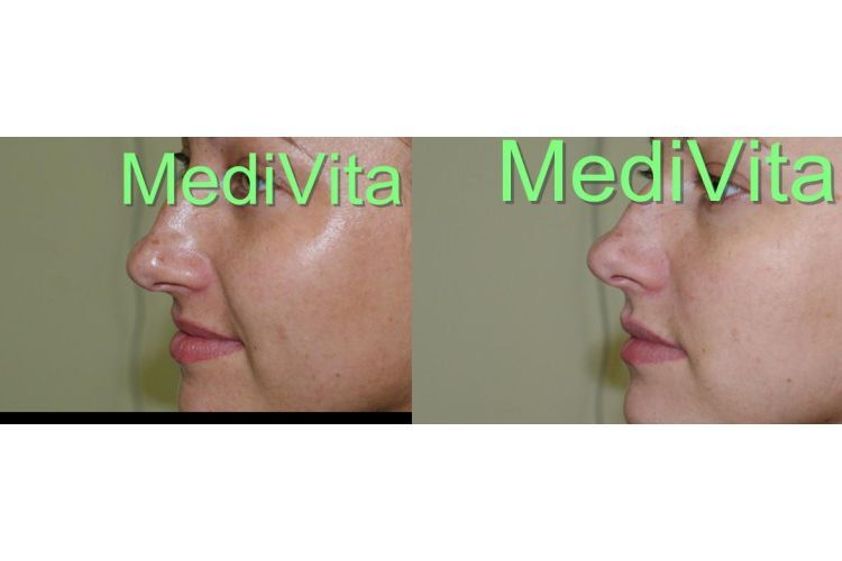 Laserowe zabiegi dermatologii estetycznej przed i po - 685393