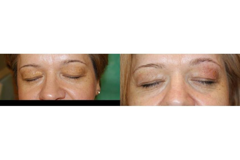 Laserowe zabiegi dermatologii estetycznej przed i po - 685396