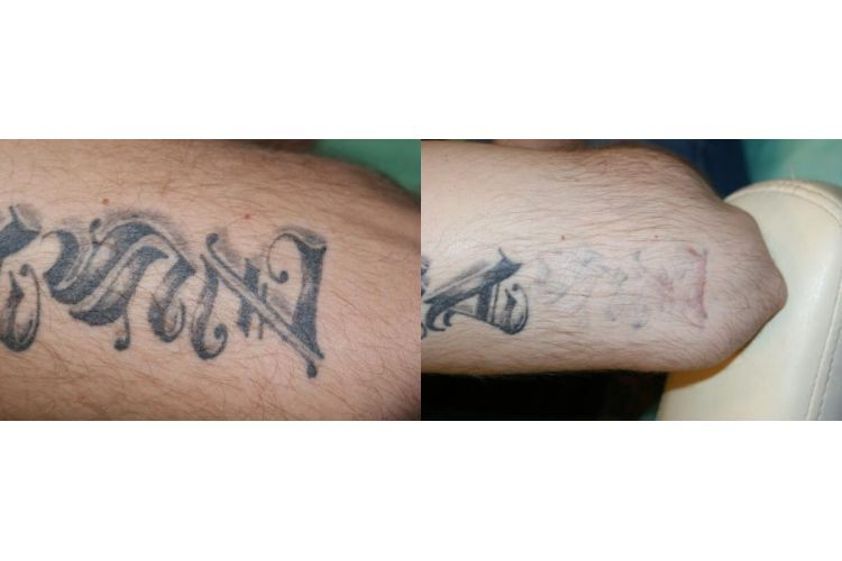 Usuwanie tatuażu przed i po - 685437