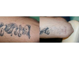 Usuwanie tatuażu - przed i po
