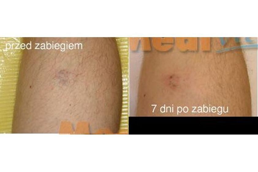 Laserowe zamykanie naczynek przed i po - 685439