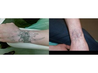 Laserowe usuwanie tatuażu - przed i po