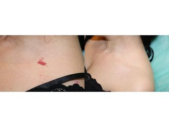 Naczyniaki przed i po - 685451