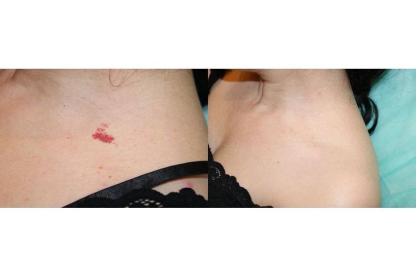 Naczyniaki przed i po - 685451