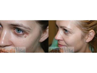 Laserowe usuwanie zmian skórnych - przed i po