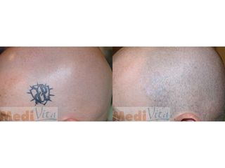 Laserowe usuwanie tatuażu - przed i po
