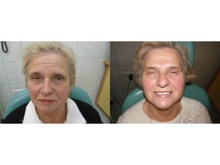 Anti-aging - przed i po