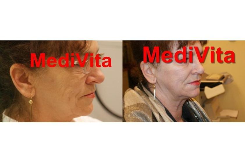Anti-aging przed i po - 685472