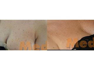 Laserowe usuwanie zmian skórnych - przed i po