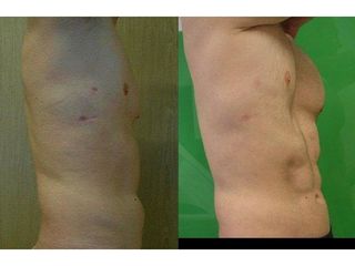 Przed i po - liposukcja ultradźwiękowa