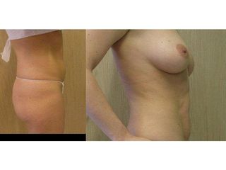 Przed i po - liposukcja ultradźwiękowa