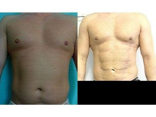 Przed i po - liposukcja ultradźwiękowa