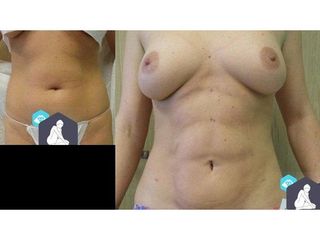 Przed i po - liposukcja ultradźwiękowa