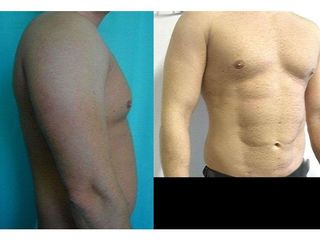 Przed i po - liposukcja ultradźwiękowa