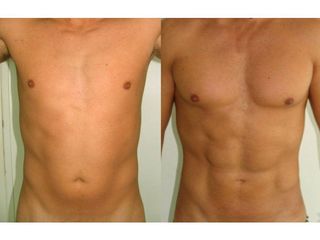 Przed i po - liposukcja