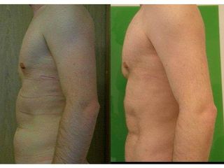 Przed i po - liposukcja ultradźwiękowa
