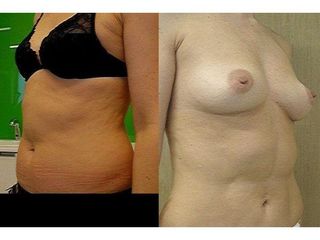 Przed i po - liposukcja ultradźwiękowa
