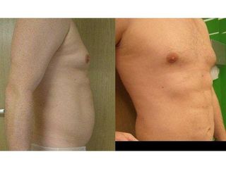 Przed i po - liposukcja ultradźwiękowa