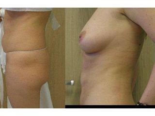 Przed i po - liposukcja ultradźwiękowa