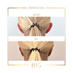 Korekcja uszu - Marina MedEstetic
