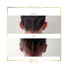 Korekcja uszu - Marina MedEstetic