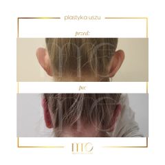 Korekcja uszu - Marina MedEstetic