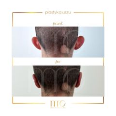 Korekcja uszu - Marina MedEstetic