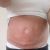 Liposukcja brzucha po urodzeniu dziecka - 6 litrów tłuszczu mniej!